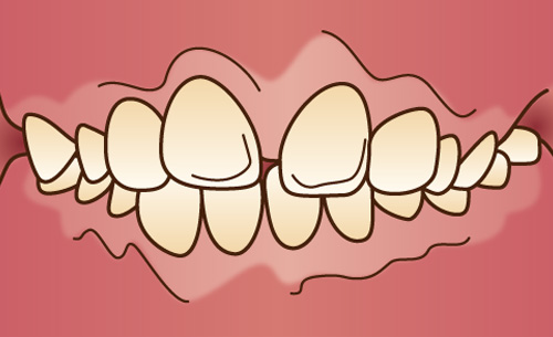 上顎前突(じょうがくぜんとつ)