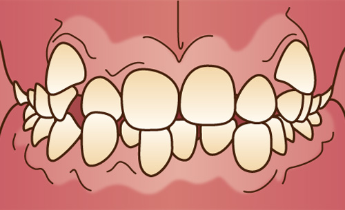叢生(そうせい)(乱ぐい歯・八重歯)