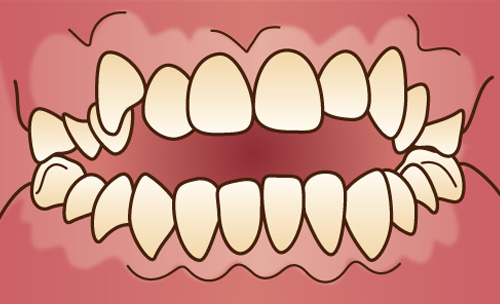 開咬(かいこう)