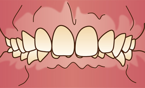 過蓋咬合(かがいこうごう)