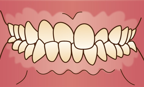 交叉咬合(こうさこうごう)